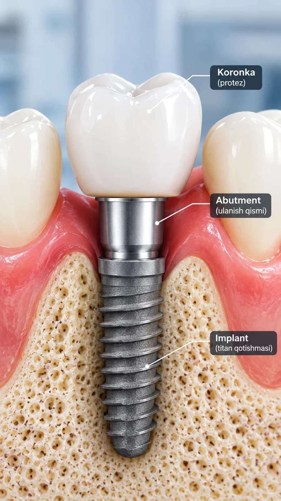 Implant